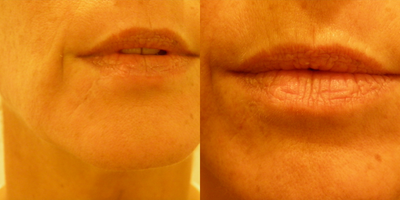 45-54 year old woman treated with Affirm Laser - Old scar treatment with Affirm Multiplex.