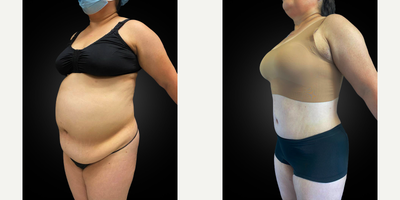 45 year old female treated with Lymphatic Massage - 45 year old female who underwent a tummy tuck with diastasis recti repair, VASER liposuction and Renuvion J Plasma skin tightening of her upper/middle/lower back, flanks, medial thighs and neck, and BBL (Brazilian Butt Lift/fat transfer to the buttocks), three months prior.