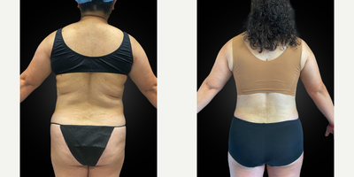 45 year old female treated with Lymphatic Massage - 45 year old female who underwent a tummy tuck with diastasis recti repair, VASER liposuction and Renuvion J Plasma skin tightening of her upper/middle/lower back, flanks, medial thighs and neck, and BBL (Brazilian Butt Lift/fat transfer to the buttocks), three months prior.