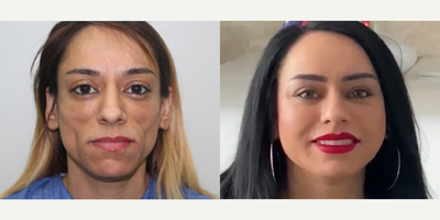 Woman treated with Cheek Augmentation - Woman treated with Cheek Augmentation through facial fat transfer