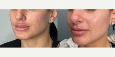 25-34 year old woman treated with CO2 Laser - patient treated with one session of Co2 Laser