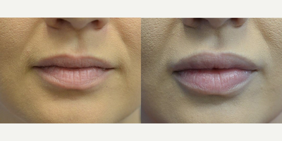 Woman treated with Juvederm, Lip Fillers - Woman treated with Juvederm, Lip Fillers