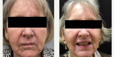65-74 year old woman treated with Total FX - Active and Deep FX (Total FX) treatment