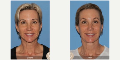 56 year old woman treated with Deep Plane Facelift, Neck Lift, Eyelid Surgery, MACS Facelift - 56 year old woman treated with Deep Plane Face and Neck Lift, Fat Grafting to Face, Lower Blepharoplasty skin Pinch, MAC