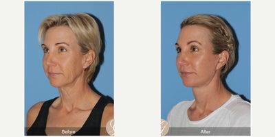 56 year old woman treated with Deep Plane Facelift, Neck Lift, Eyelid Surgery, MACS Facelift - 56 year old woman treated with Deep Plane Face and Neck Lift, Fat Grafting to Face, Lower Blepharoplasty skin Pinch, MAC
