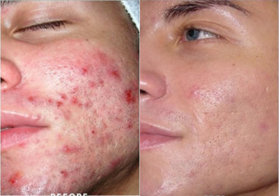 Man treated with Dermalinfusion - Man treated with Dermalinfusion