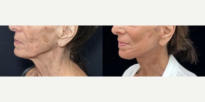 76 year old woman treated with Deep Plane Facelift, Neck Lift, Facial Fat Transfer, CO2 Laser - 76 year old woman treated with Deep Plane Facelift, Neck Lift, Facial Fat Transfer, CO2 Laser