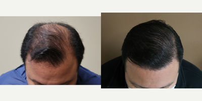 35-44 year old man treated with NeoGraft - This gentleman was unhappy with his male pattern baldness and decided to undergo Neograft FUE hair transplantation. 3100 FUE were extracted from the occipital scalp donor site and transferred to the frontal scalp as well as crown.