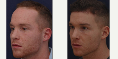 25- 34  year old man treated with Forehead Reduction (Dr. Aharonov and Dr. Pak) - Surgical Forehead Reduction - By Dr. Gal Aharonov 
Hair transplant in front of the reduction scar and corner rounding and on to the scar - By Dr. Jae Pak