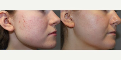 25-34 year old woman treated with PRP Injections, Vampire Facial - 13130: vampire facial25 yo, F, 55, 127lbs, G0P0