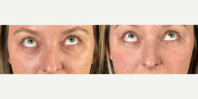 35-44 year old woman treated with Vollure - Under eye filler is a great option for those wanting to get rid of under eye hollows, dark circles and camouflage bags.