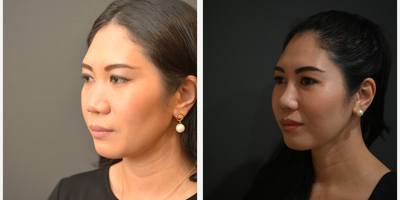35-44 year old woman treated with Asian Rhinoplasty - Augmentation Asian Rhinoplasty and tip elevation with alar base trim