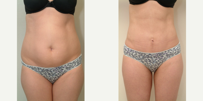 25-34 year old woman treated with Mini Tummy Tuck - Abdominal looseness after pregnancy.