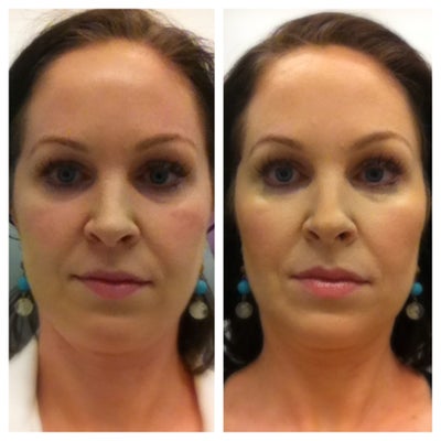 Juvederm Voluma - Juvederm Voluma administered by Michael Law MD. The Voluma was injected in the cheeks and cheekbones increasing the volume in the area.&nbsp;