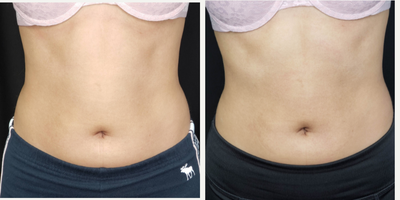 18-24 year old woman treated with CoolTone - Results photos are taken immediately after the 6th treatment. Six treatments, each 48 hours apart.