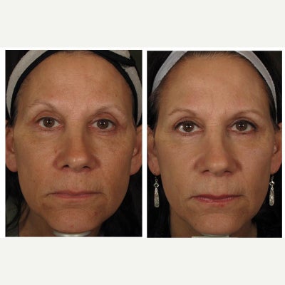 45-54 year old woman treated with Halo Laser - Pt. had a single Halo laser treatment