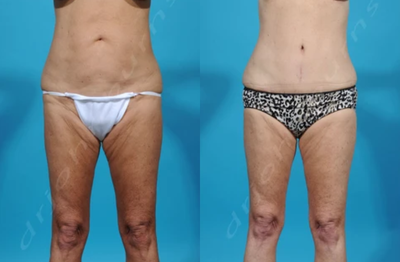Woman treated with Mini Tummy Tuck - Woman treated with Mini Tummy Tuck with Liposuction of the Flanks