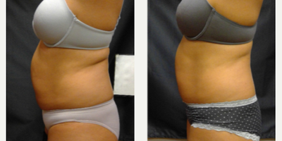 35-44 year old woman treated with BodyFX - Patient after 1 treatment.