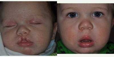 17 or under year old man treated with Cleft Lip And Palate Repair - bilateral cleft lip