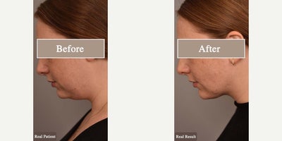 Woman treated with Chin Liposuction - Woman treated with Chin/Neck Liposuction, Cheek Liposuction, and Buccal Fat Removal. Patient is shown before and 3 months post-op.