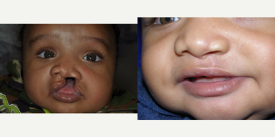 17 or under year old man treated with Cleft Lip And Palate Repair - cleft lip repair