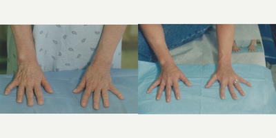 Fat injection to hands - Patient had Hand Rejuvenation by having fat harvested from the abdomen and transfered to the top of the hands for a more youthful apperance.