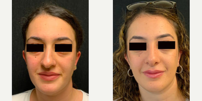 Woman treated with Rhinoplasty - Woman treated with Rhinoplasty