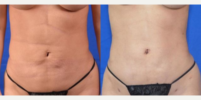 Woman treated with Liposuction Revision - Woman treated with Liposuction Revision