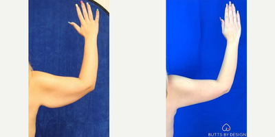 Woman treated with Arm Lift - Woman treated with Arm Lift