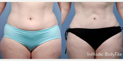 Woman treated with Vaser Liposuction, BodyTite, Emsculpt - Woman treated with Vaser Liposuction, BodyTite, Emsculpt