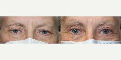 65-74 year old man treated with Upper Eyelid External Ptosis Repair - 65-74 year old man treated with Upper Eyelid External Ptosis Repair