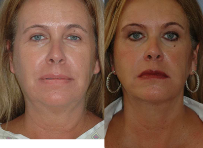 Precision TX Laser Lift  - Age: 55, Ht: 5'7, Wt: 170, Procedure: Laser lift to neck and jawline. Four months between before and after photos