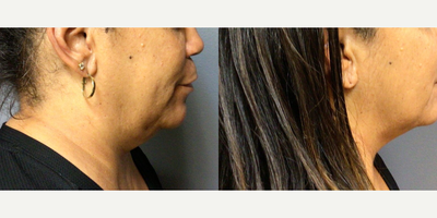 55-64 year old woman treated with Profound RF - 58-year-old female presented for nonsurgical tightening of the skin on her neck and chin. She underwent one Profound treatment and was happy with her results at four months post treatment. Further improvement can be noted for up to six months post treatment.
