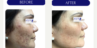 35-44 year old woman treated with Laser Resurfacing, CO2 Laser, YAG Laser, Fractional Laser, UltraPulse CO2 Laser, Facial - LASER ACNE TREATMENT