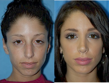Rhinoplasty - Woman treated with Septoplasty and Rhinoplasty