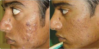 Pixel Laser - Man treated with Pixel Laser