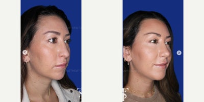 35-44 year old woman treated with Chin Implant, Revision Rhinoplasty - 35-44 year old woman treated with Revision Rhinoplasty, Chin Implant