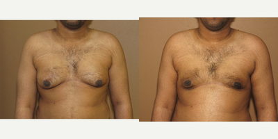 25-34 year old man treated with Male Breast Reduction - Male breast reduction (gynecomastia)