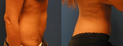 45-54 year old woman treated with Tummy Tuck - After considering her options for body contouring surgery, this 52-year-old Sacramento-area woman chose tummy tuck surgery at our practice. During the procedure, Dr. Yamahata removed excess skin and fat and tightened her abdominal muscles for a comprehensive, long-lasting improvement. Patient Age: 52Patient Gender: Female