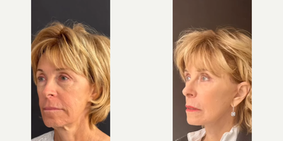 Woman treated with Facial Fat Transfer - Woman treated with Deep Plane Facelift, Neck Lift, Lateral Brow Lift, and Facial Fat Transfer.