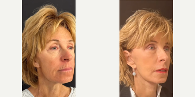 Woman treated with Facial Fat Transfer - Woman treated with Deep Plane Facelift, Neck Lift, Lateral Brow Lift, and Facial Fat Transfer.