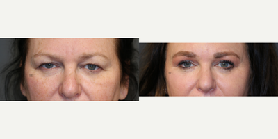 Enigmalift and fat transfer. - Enigmalift Browlift and eyelid lift with fat transfer and non-surgical neck tightening and lip lift.