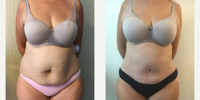 45-54 year old woman treated with Tummy Tuck - Tummy Tuck Surgery performed by DR. Ozge Ergun