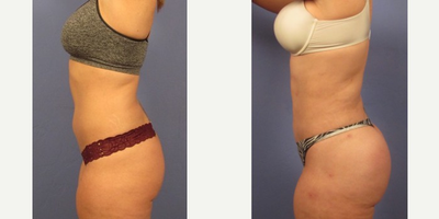 25-34 year old woman treated with Liposuction - Liposuction of abdomen. Fat transferred to her buttock.