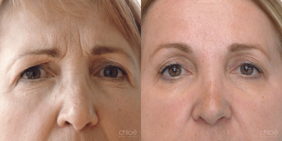 Non Surgical Eyelid Lift using Botox - With age, the line of the eyebrows becomes lower and the skin around the eyes becomes saggy, which can give a tired and sad look. This phenomenon can also be observed in younger patients. This condition can be effectively treated with neuromodulators.