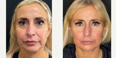 55-64 year old woman treated with NeoGen Plasma - NeoGen Plasma has been a game changer for Skin MD patients!  Results will continue to improve over 9 to 12 months.