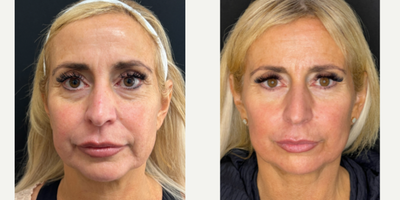 45-54 year old woman treated with NeoGen Plasma, Skin Rejuvenation - Amazing results achieved for this patient -- NeoGen Plasma Resurfacing has been a game changer for our patients! The results shown here are 30 days out. Results will continue to improve over the next 9 months!