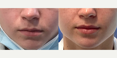 18-24 year old woman treated with Juvederm - This patient was treated with 1 syringe of Juvederm Ultra.