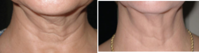 55-64 year old woman treated with Skintyte - 55-64 year old woman treated with Skintyte