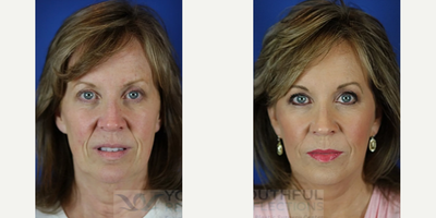 45-54 year old woman treated with Facial Fat Transfer, Facelift - Procedures Performed:Fat TransferFacelift / Reflection Lift